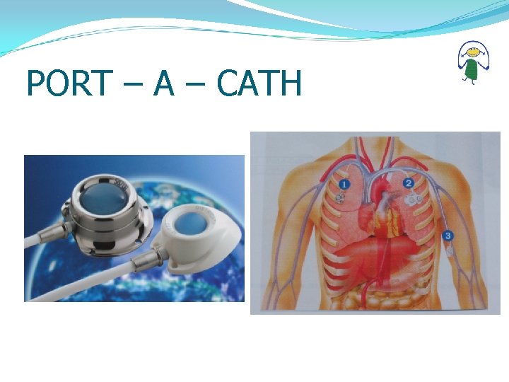 PORT – A – CATH 