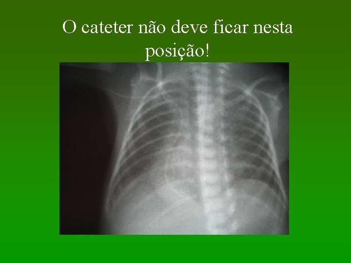 O cateter não deve ficar nesta posição! 