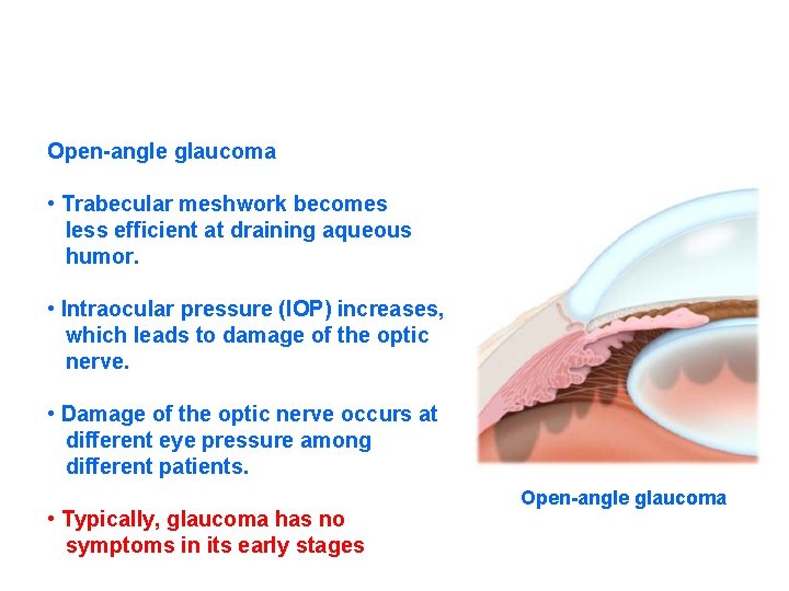 Open-angle glaucoma • Trabecular meshwork becomes less efficient at draining aqueous humor. • Intraocular