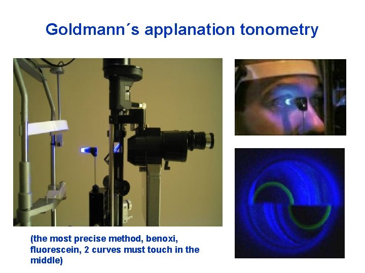 Goldmann´s applanation tonometry (the most precise method, benoxi, fluorescein, 2 curves must touch in