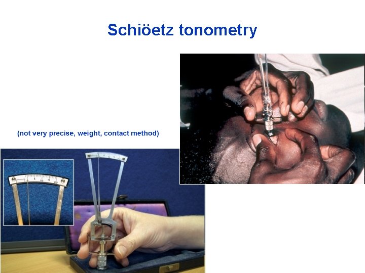 Schiöetz tonometry 