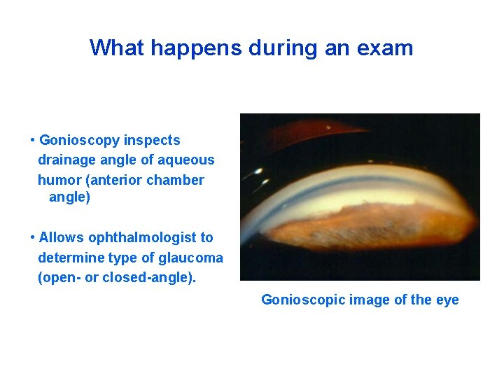 What happens during an exam • Gonioscopy inspects drainage angle of aqueous humor (anterior