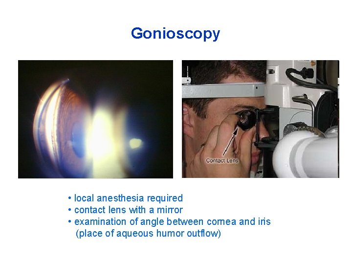 Gonioscopy • local anesthesia required • contact lens with a mirror • examination of