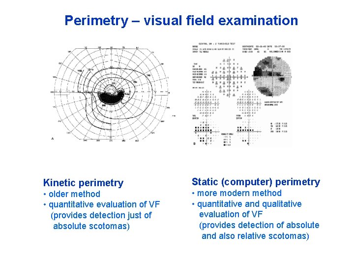 Perimetry – visual field examination Kinetic perimetry • older method • quantitative evaluation of