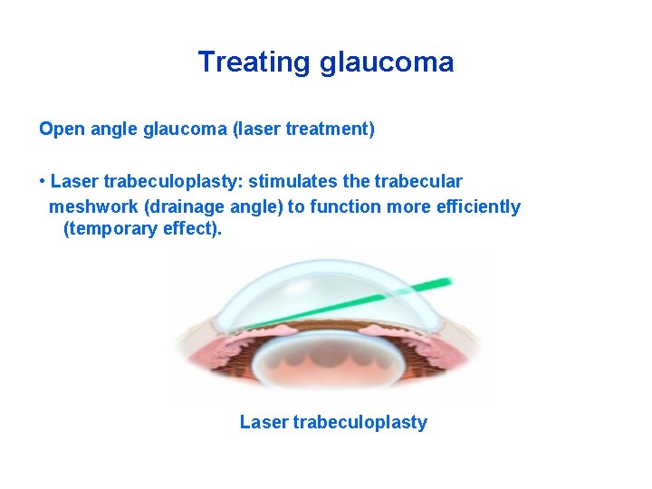 Treating glaucoma Open angle glaucoma (laser treatment) • Laser trabeculoplasty: stimulates the trabecular meshwork