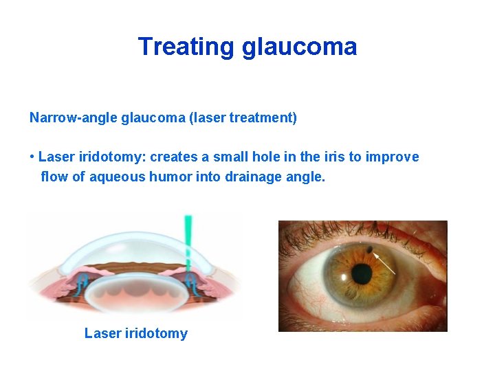 Treating glaucoma Narrow-angle glaucoma (laser treatment) • Laser iridotomy: creates a small hole in