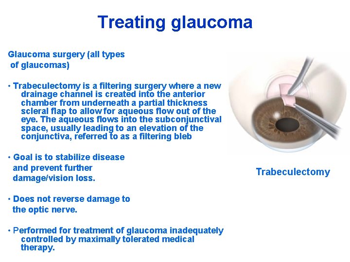 Treating glaucoma Glaucoma surgery (all types of glaucomas) • Trabeculectomy is a filtering surgery