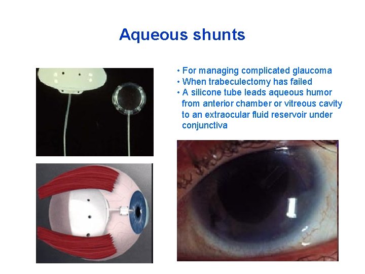 Aqueous shunts • For managing complicated glaucoma • When trabeculectomy has failed • A