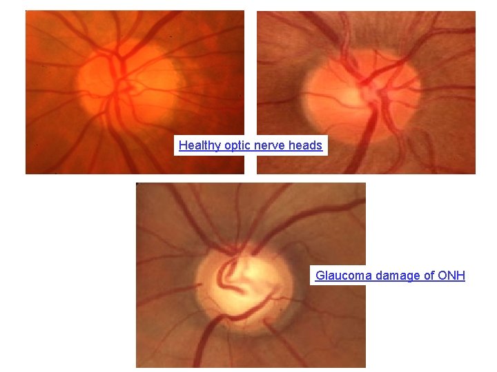 Healthy optic nerve heads Glaucoma damage of ONH 