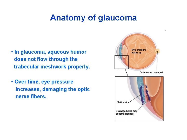 Anatomy of glaucoma • In glaucoma, aqueous humor does not flow through the trabecular