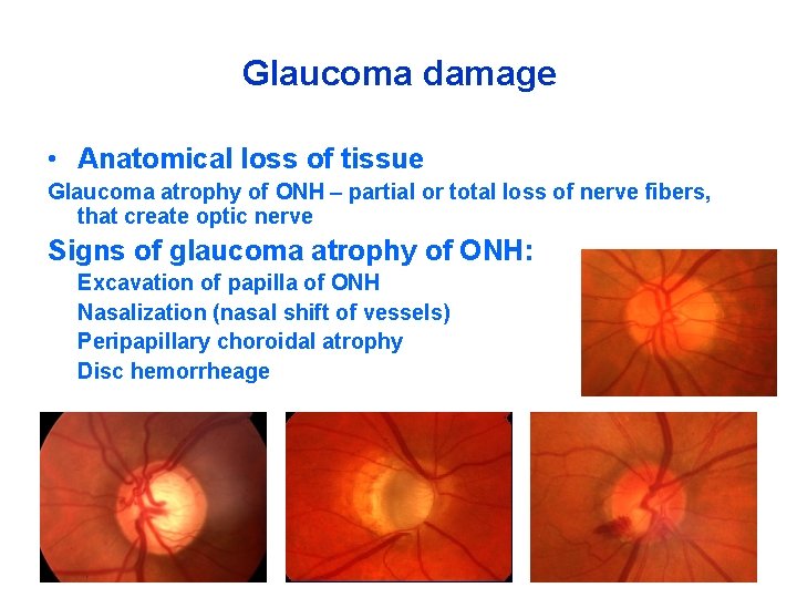 Glaucoma damage • Anatomical loss of tissue Glaucoma atrophy of ONH – partial or