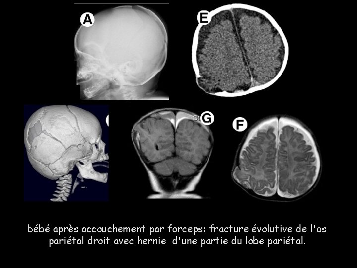 bébé après accouchement par forceps: fracture évolutive de l'os pariétal droit avec hernie d'une