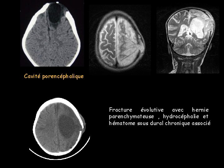 Cavité porencéphalique Fracture évolutive avec hernie parenchymateuse , hydrocéphalie et hématome sous dural chronique