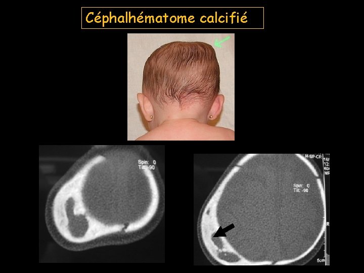 Céphalhématome calcifié 