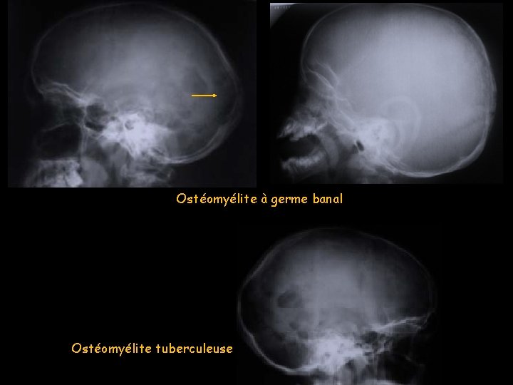Ostéomyélite à germe banal Ostéomyélite tuberculeuse 