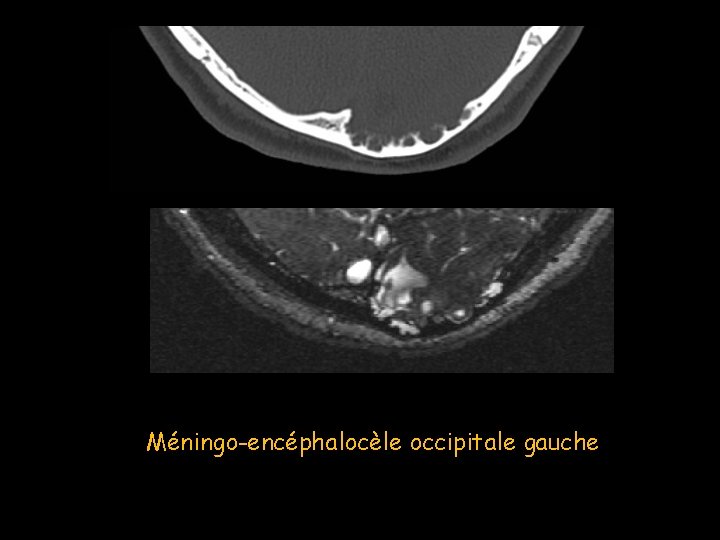 Méningo-encéphalocèle occipitale gauche 