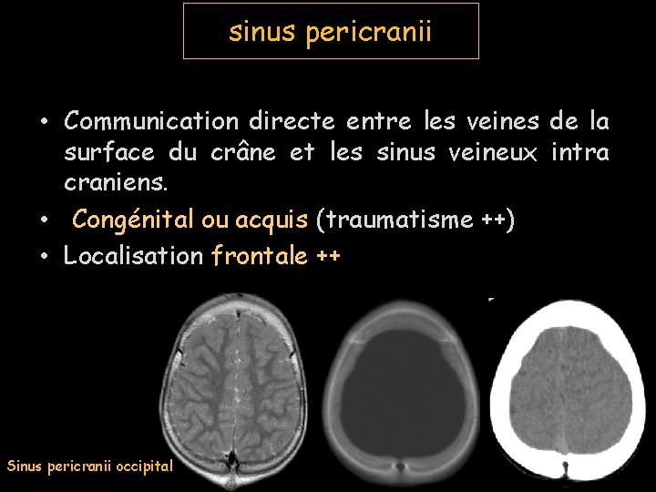sinus pericranii • Communication directe entre les veines de la surface du crâne et