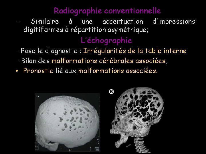 Radiographie conventionnelle - Similaire à une accentuation d’impressions digitiformes à répartition asymétrique; L’échographie –