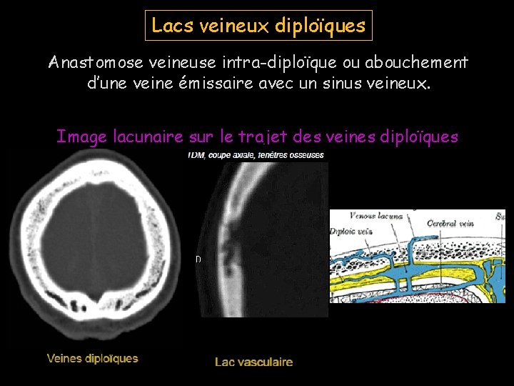 Lacs veineux diploïques Anastomose veineuse intra-diploïque ou abouchement d’une veine émissaire avec un sinus