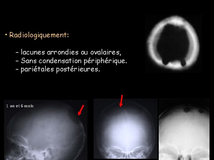 Lacunes physiologiques • Radiologiquement: – lacunes arrondies ou ovalaires, – Sans condensation périphérique. –