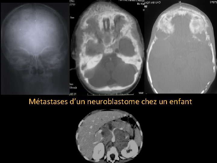 Métastases d’un neuroblastome chez un enfant 