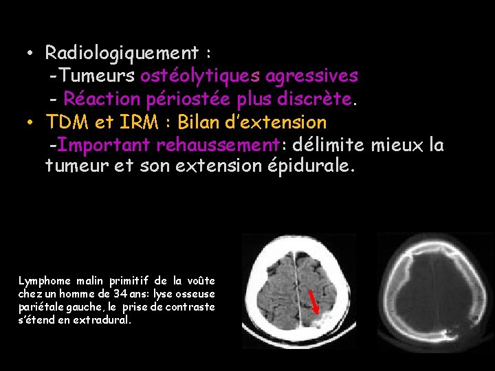  • Radiologiquement : -Tumeurs ostéolytiques agressives - Réaction périostée plus discrète. • TDM