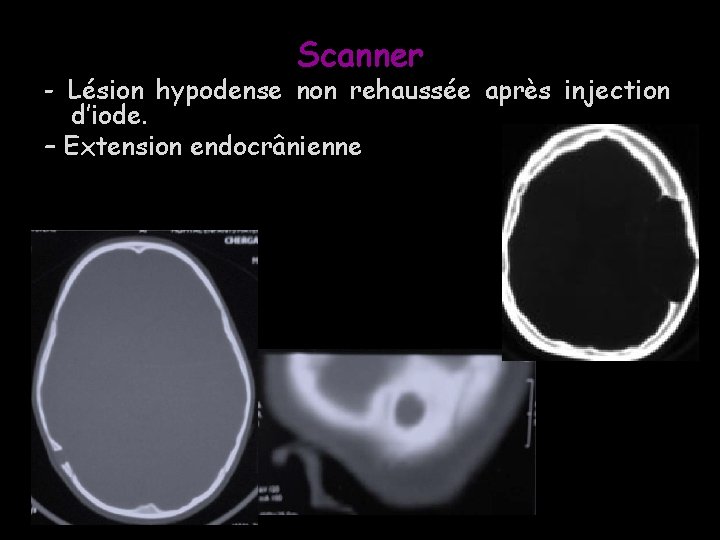 Scanner - Lésion hypodense non rehaussée après injection d’iode. – Extension endocrânienne 