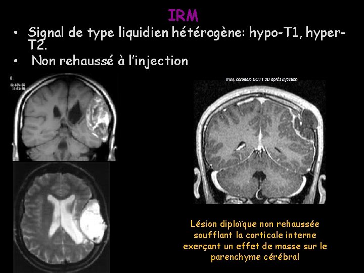 IRM • Signal de type liquidien hétérogène: hypo-T 1, hyper. T 2. • Non