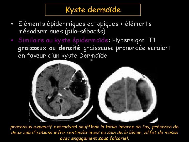 Kyste dermoïde • Eléments épidermiques ectopiques + éléments mésodermiques (pilo-sébacés) • Similaire au kyste