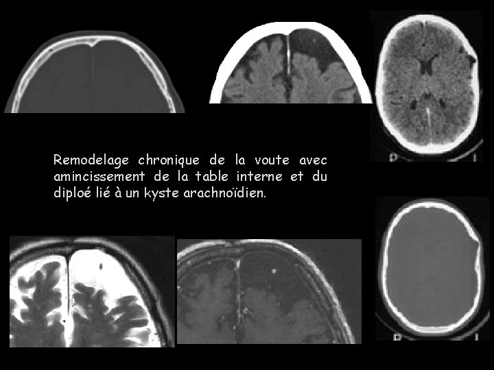 Remodelage chronique de la voute avec amincissement de la table interne et du diploé