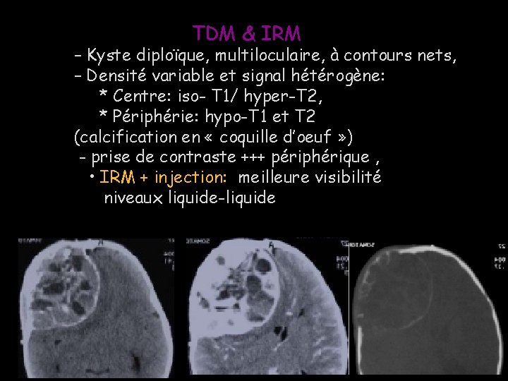 TDM & IRM – Kyste diploïque, multiloculaire, à contours nets, – Densité variable et