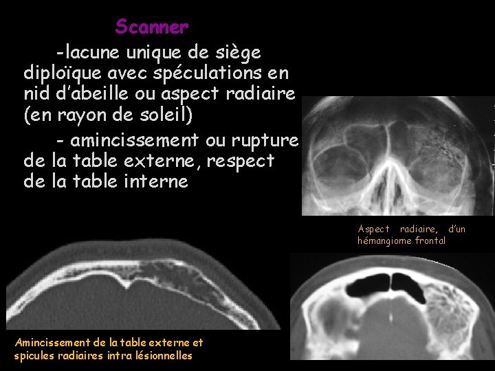 Scanner -lacune unique de siège diploïque avec spéculations en nid d’abeille ou aspect radiaire