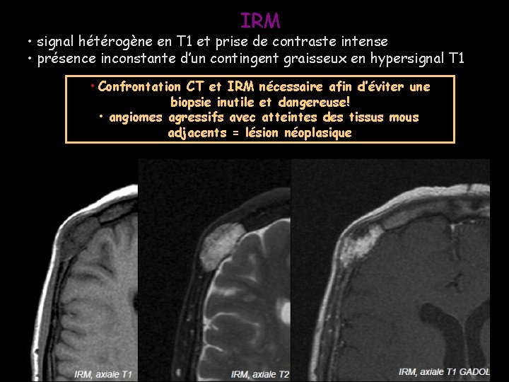 IRM • signal hétérogène en T 1 et prise de contraste intense • présence