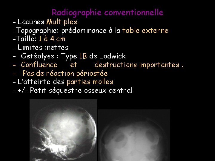 Radiographie conventionnelle - Lacunes Multiples -Topographie: prédominance à la table externe -Taille: 1 à