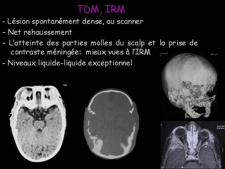 TDM, IRM - Lésion spontanément dense, au scanner – Net rehaussement – L’atteinte des