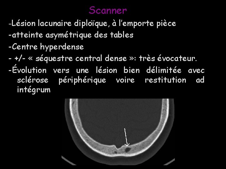 Scanner -Lésion lacunaire diploïque, à l’emporte pièce -atteinte asymétrique des tables -Centre hyperdense -