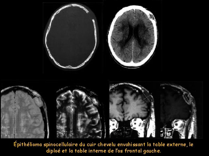 Épithélioma spinocellulaire du cuir chevelu envahissant la table externe, le diploé et la table