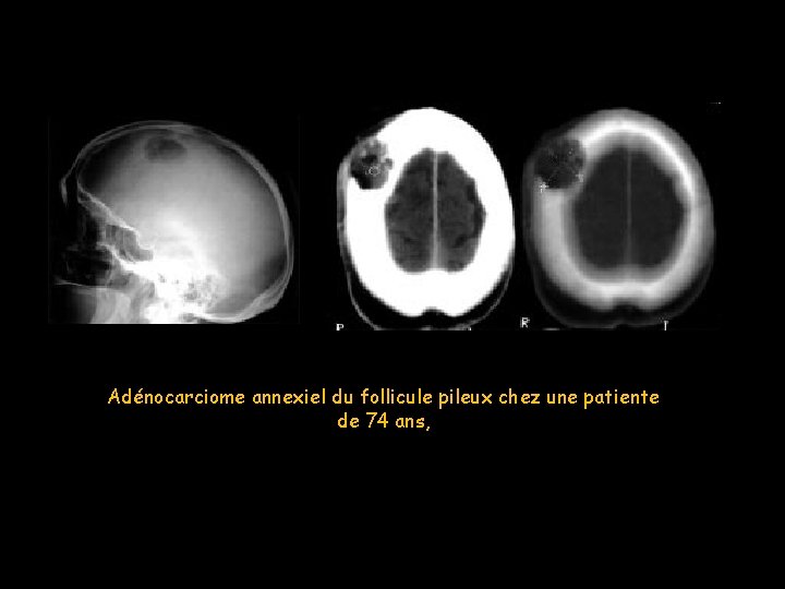 Adénocarciome annexiel du follicule pileux chez une patiente de 74 ans, 