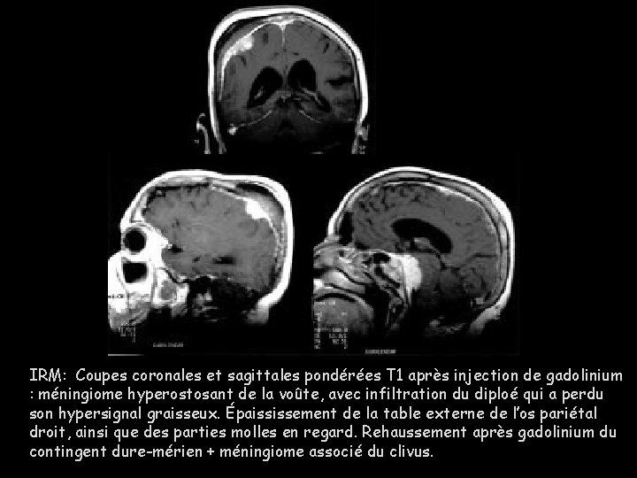 IRM: Coupes coronales et sagittales pondérées T 1 après injection de gadolinium : méningiome
