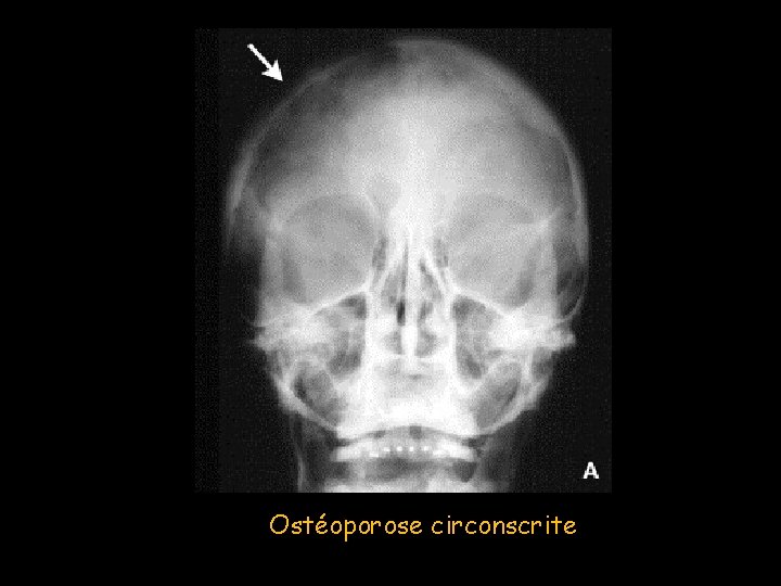 Ostéoporose circonscrite 