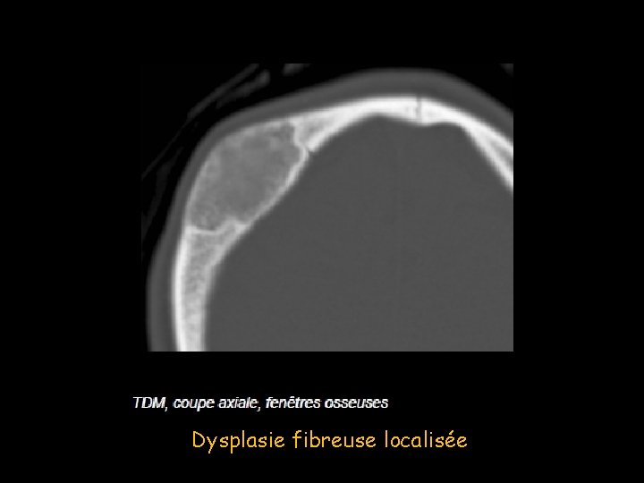 Dysplasie fibreuse localisée 