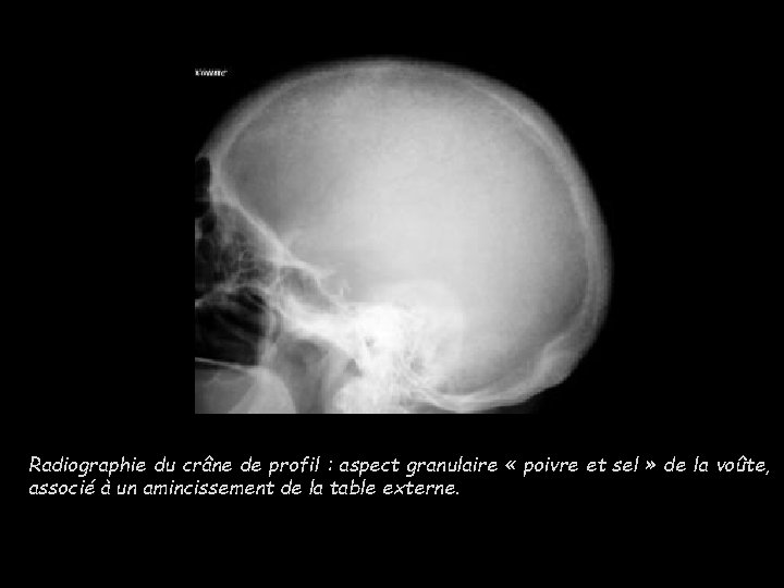 Radiographie du crâne de profil : aspect granulaire « poivre et sel » de