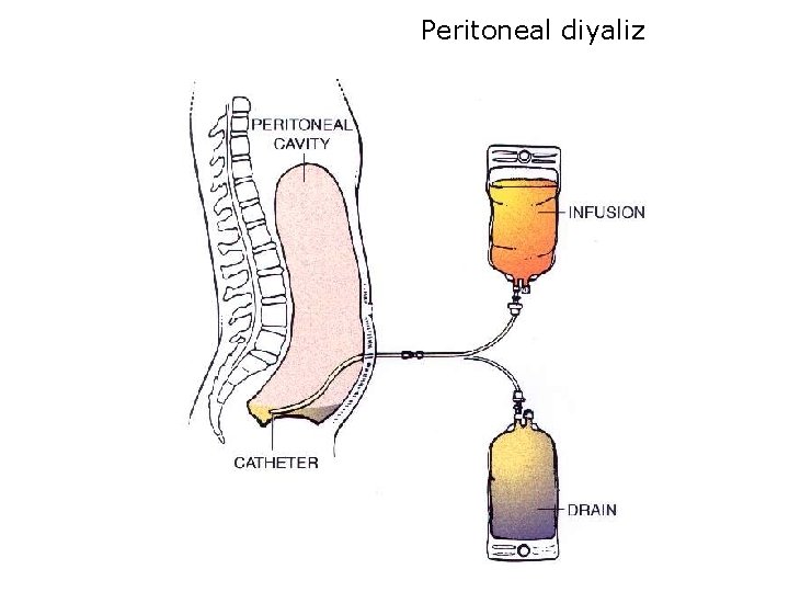 Peritoneal diyaliz 