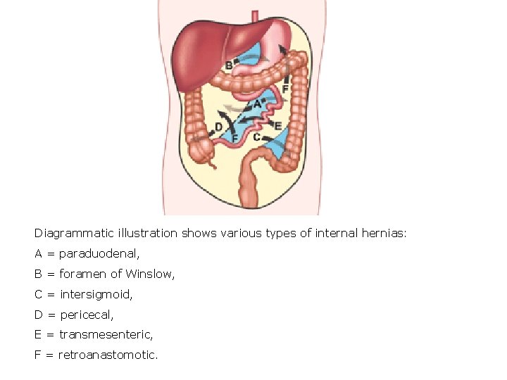 Diagrammatic illustration shows various types of internal hernias: A = paraduodenal, B = foramen