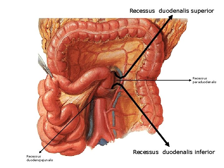 Recessus duodenalis superior Recessus paraduodenalis Recessus duodenojejunalis Recessus duodenalis inferior 