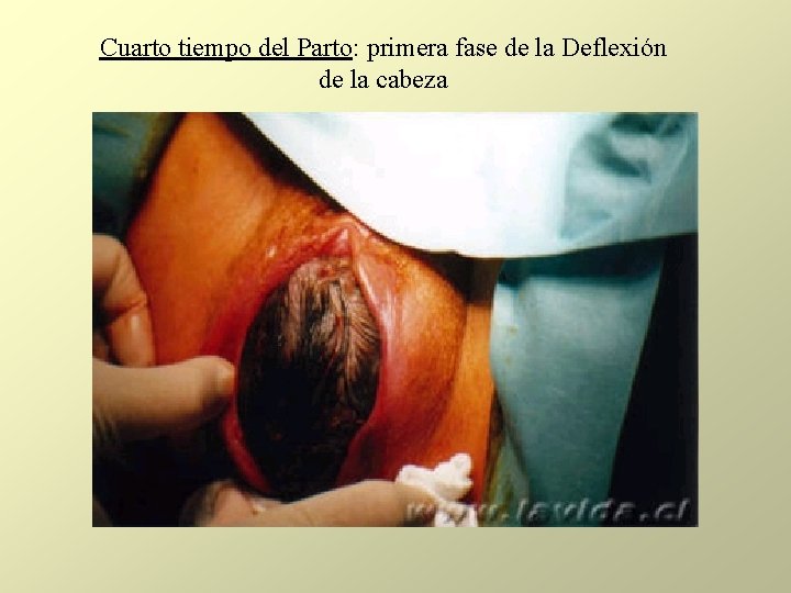 Cuarto tiempo del Parto: primera fase de la Deflexión de la cabeza Cuarto tiempo del Parto: primera fase de la Deflexión de la cabeza