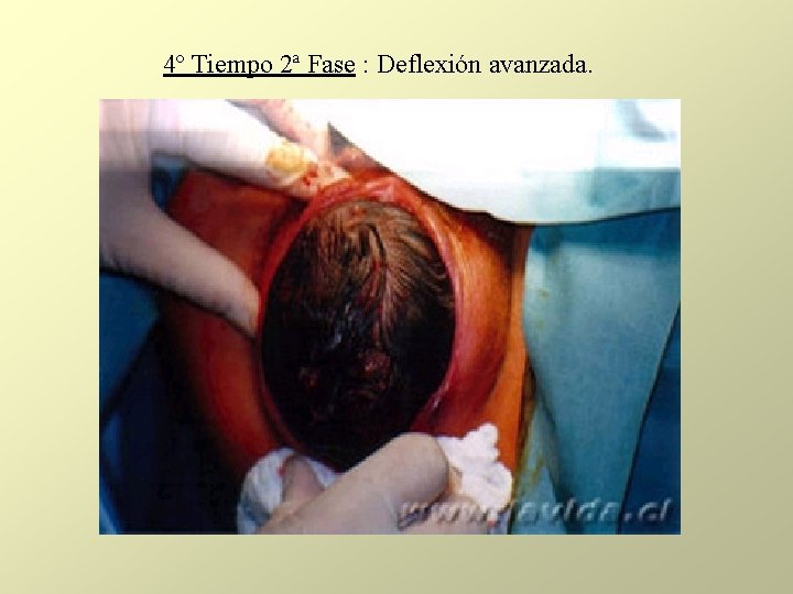 4º Tiempo 2ª Fase : Deflexión avanzada. 4º Tiempo 2ª Fase : Deflexión avanzada.