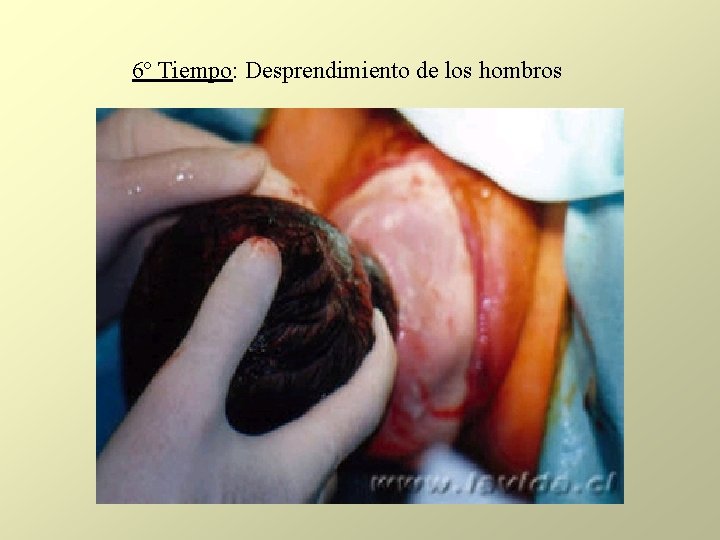 6º Tiempo: Desprendimiento de los hombros 6º Tiempo: Desprendimiento de los hombros