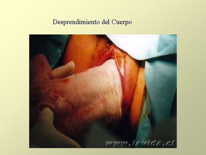 Desprendimiento del Cuerpo Desprendimiento del Cuerpo