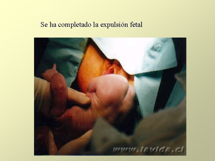 Se ha completado la expulsión fetal Se ha completado la expulsión fetal